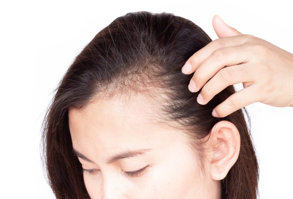 androgenetic alopecia, female hair loss